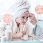 cam-nang-dieu-tri-nep-nhan-1