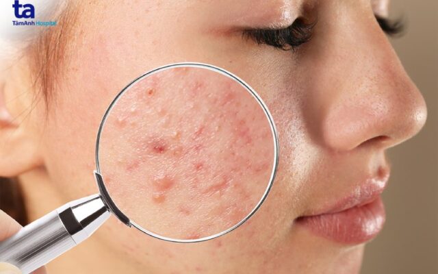 Top những nguyên nhân khiến bạn nổi mụn khắp người vào mùa hè