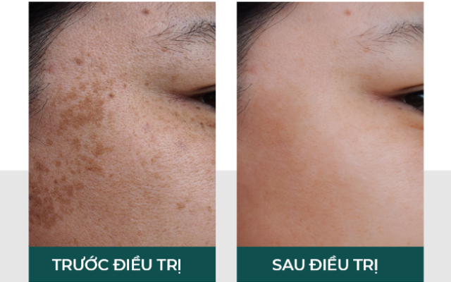 Trị nám