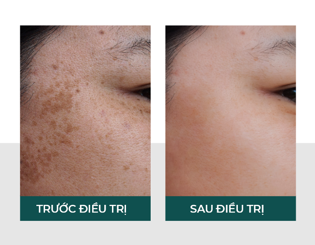 Trị nám